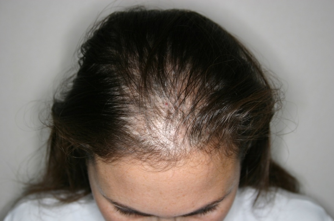 A close-up top view of a scalp showing significant hair thinning and visible scalp exposure at the crown area. The dark hair appears sparse in the central region, which is characteristic of stress-related hair loss patterns. The clinical nature of the image effectively demonstrates the condition.