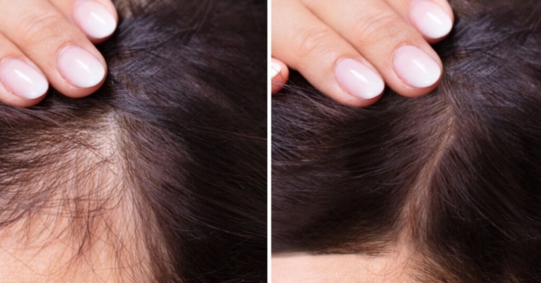 A side-by-side comparison showing fingers parting hair to reveal thinning areas. The left image shows more visible scalp and sparse hair, while the right appears to show improved density. This demonstrates how stress-related hair loss might be examined by a dermatologist or hair specialist.