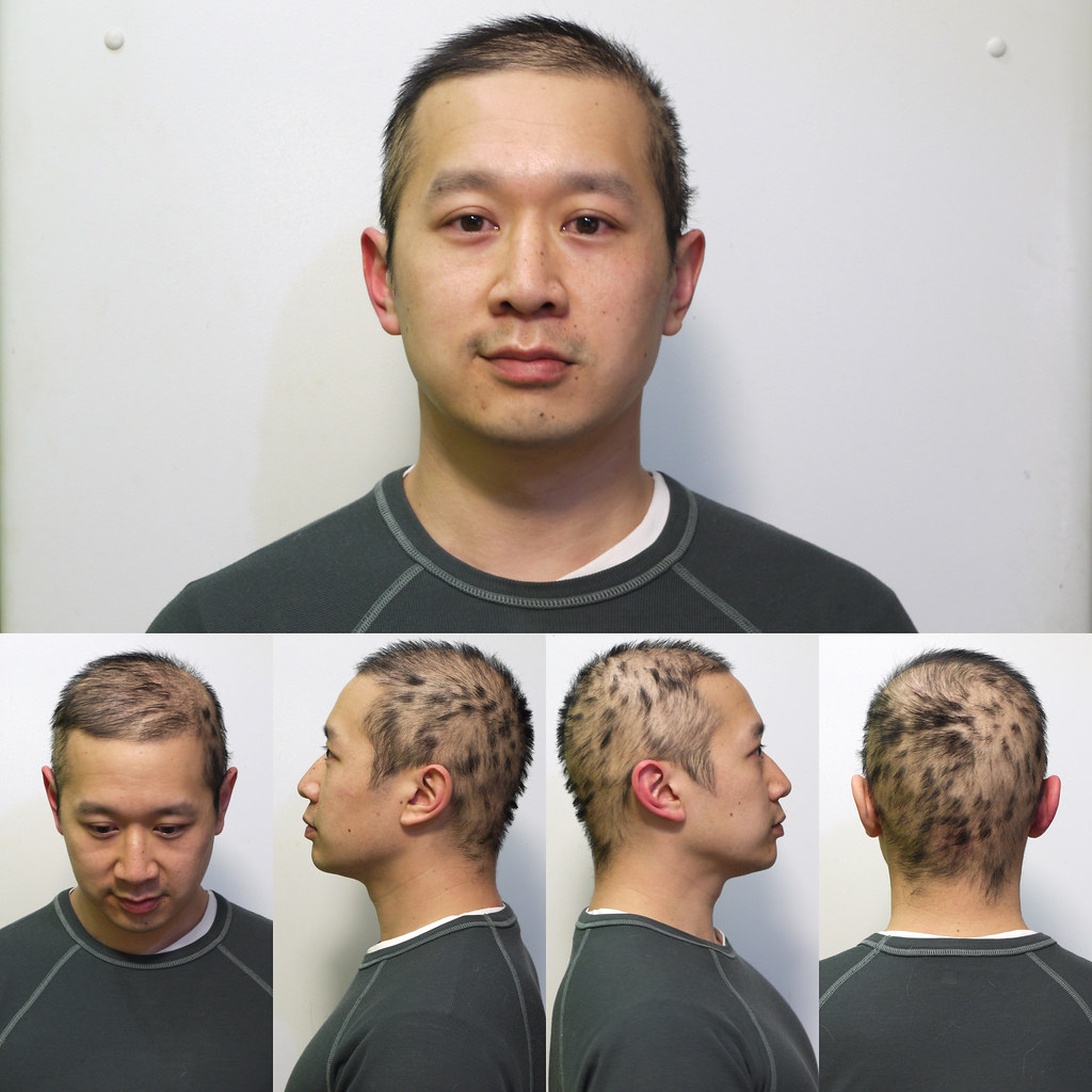 A medical documentation format showing multiple views of a person with patchy hair loss. The images display significant areas of hair loss across different sections of the scalp, particularly visible in the side and back views, consistent with stress-induced alopecia areata patterns.